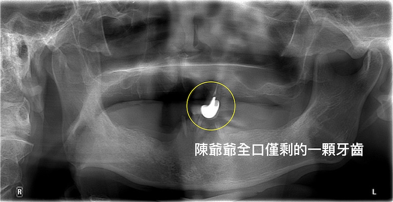 全口無牙面容凹陷，植體覆蓋式活動假牙重建後更顯年輕｜新北三重