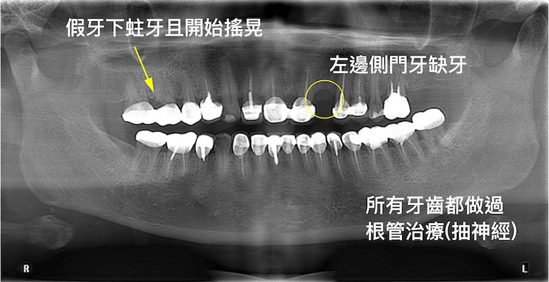 假牙蛀牙且牙齒搖晃，拔牙後採植牙重建咬合｜新北三重