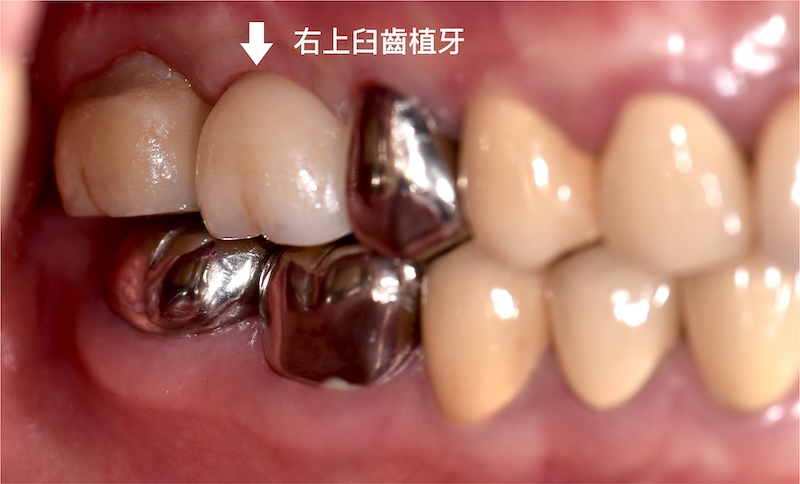 假牙蛀牙，拔牙以植牙重建後的右側咬合近照