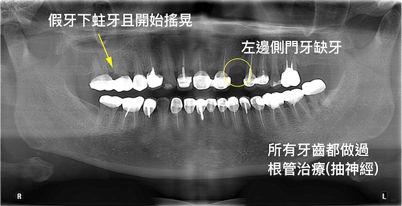 新北三重患者植牙前X光片：全口做過根管治療，假牙蛀牙且牙齒搖晃，並有左邊側門牙缺牙問題