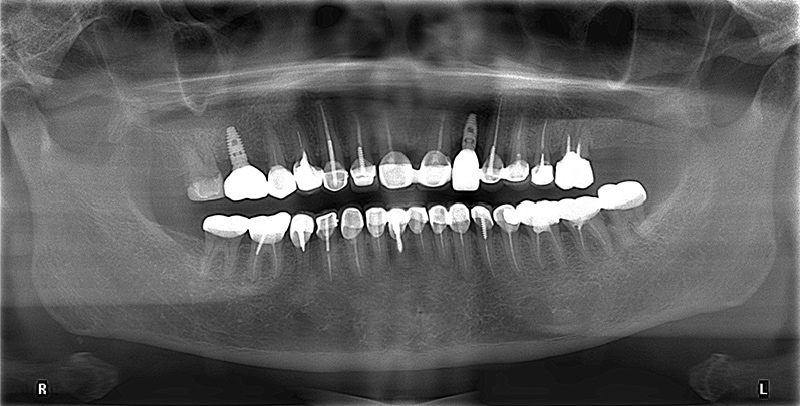 假牙蛀牙拔牙、缺牙植牙完成後的X光片