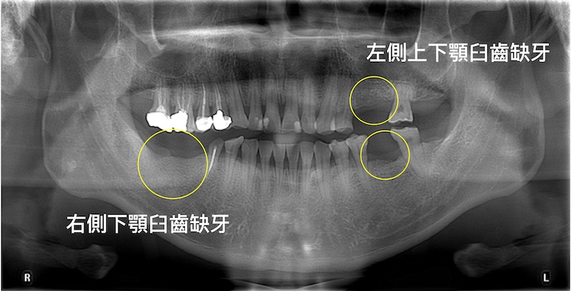 桃園患者植牙前X光片，左右兩側臼齒缺牙