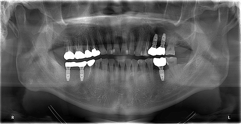 臼齒植牙術後X光片，於人工牙根上安裝牙冠完成5顆植牙