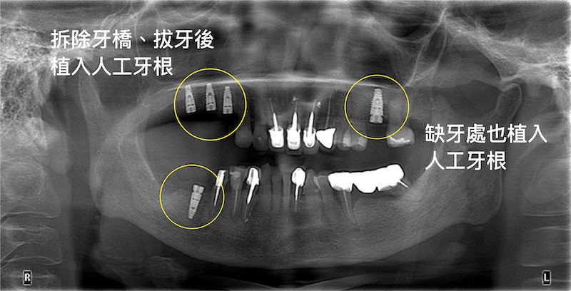 拆除牙橋、拔除無救牙，於缺牙處植入植體後的X光片