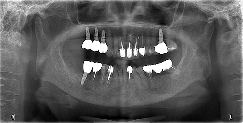 植牙完成後的全口X光片：拆除右上牙橋改植牙，並完成右下、左上的臼齒植牙