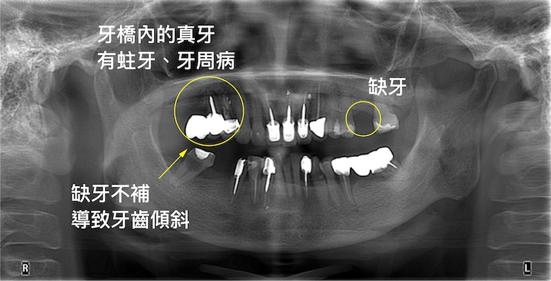 新北三重患者植牙前X光片：右上牙橋內有蛀牙及牙周病、右下臼齒缺牙導致相鄰牙齒傾斜；左側後牙區也有缺牙問題