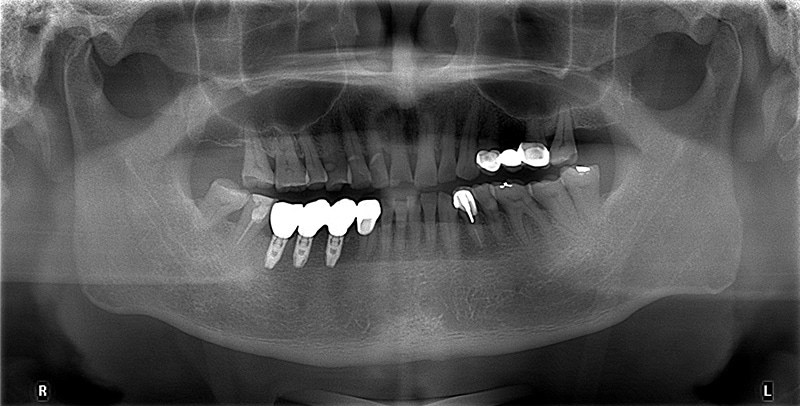 牙橋引發牙根斷裂後遺症，重做植牙咬合力更佳｜新北三重
