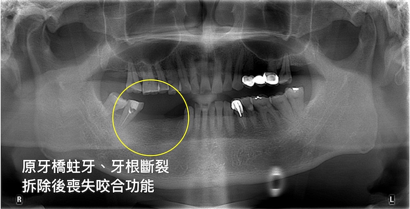 新北三重患者植牙前X光片：原右下牙橋因出現蛀牙、牙根斷裂後遺症而拆除
