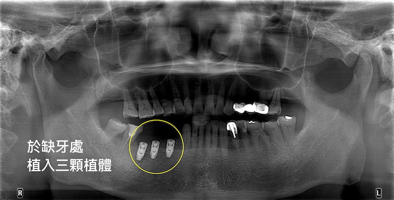 拆除牙橋，於缺牙處植入人工牙根的X光片