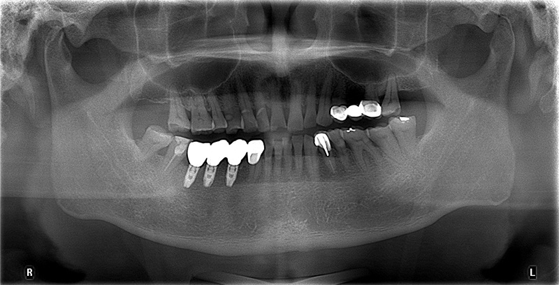 拆除牙橋後，完成3顆人工植牙的X光片