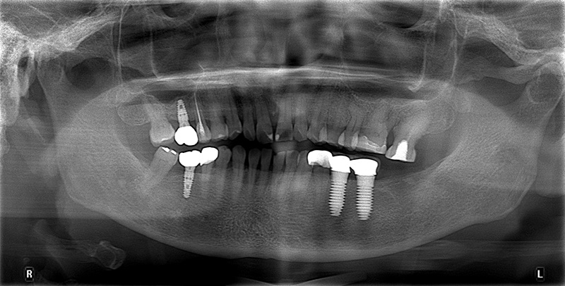 臼齒植牙-臼齒缺牙-新北-三重植牙-推薦-廖富洲醫師