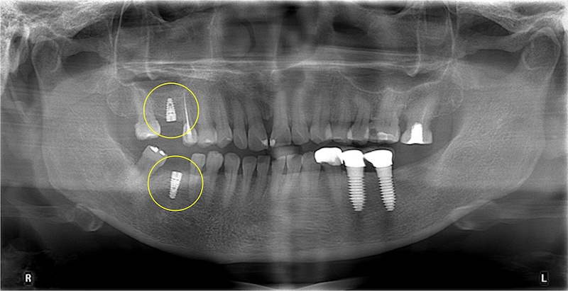 臼齒植牙術中X光片，於臼齒缺牙處植入植體