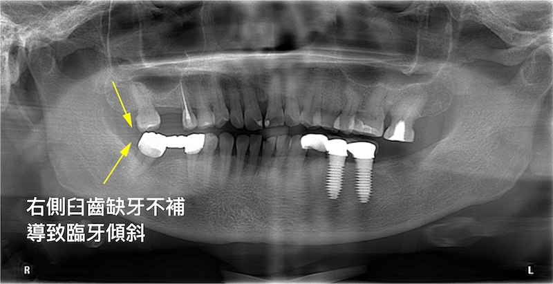 新北三重患者的臼齒缺牙X光片，缺牙導致相鄰牙齒傾倒