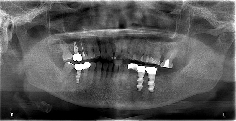 臼齒植牙術後X光片，於植體上安裝牙冠完成臼齒缺牙重建