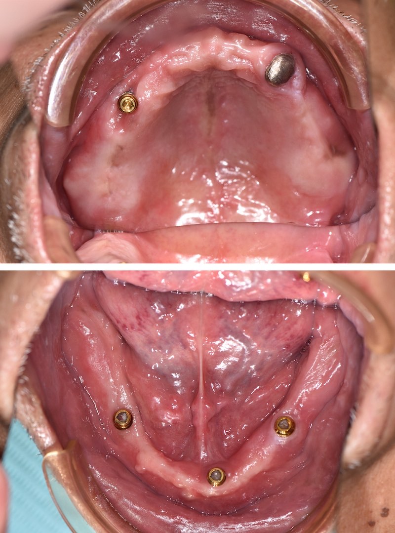 植體覆蓋式活動假牙全口重建術中口腔近照