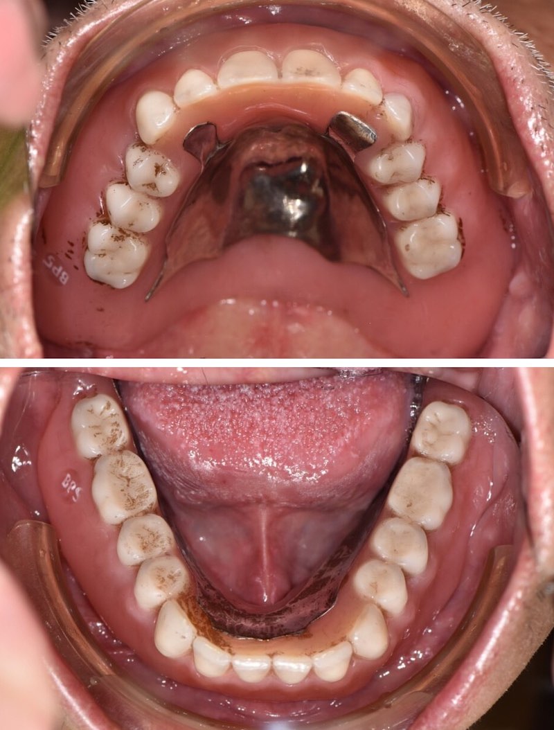 植體覆蓋式活動假牙全口重建後上下顎口腔近照