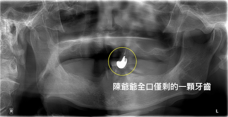新北三重患者的全口缺牙X光片，僅剩一顆牙齒機乎全口無牙