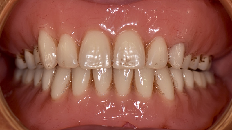 植體覆蓋式活動假牙全口重建後口腔正面近照