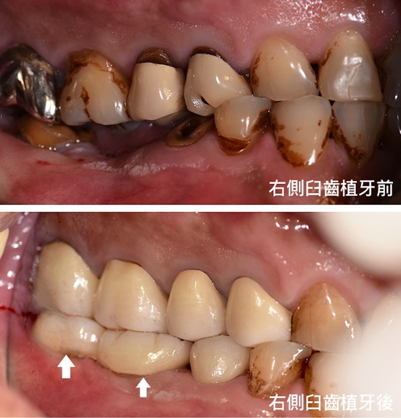 右側大臼齒缺牙與植牙前後對比照
