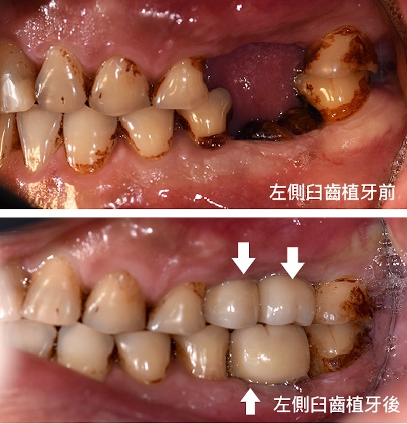 左側臼齒缺牙與植牙前後對比照