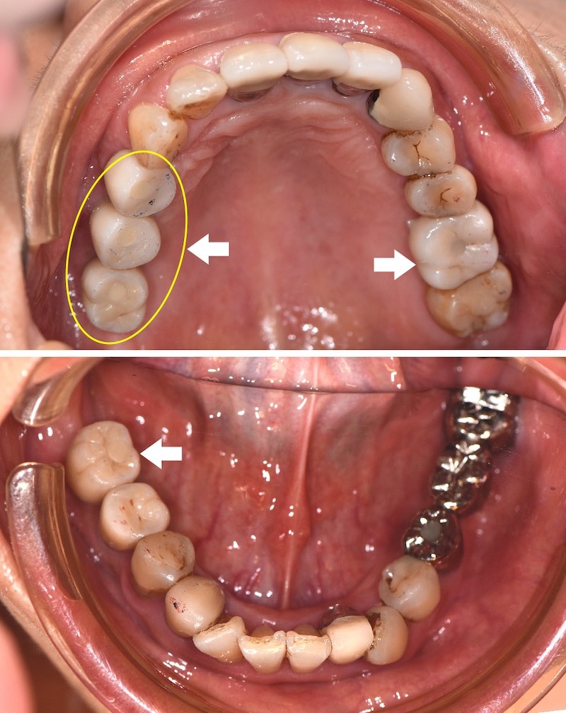 拆除牙橋改植牙、臼齒缺牙植牙後上下顎口腔近照
