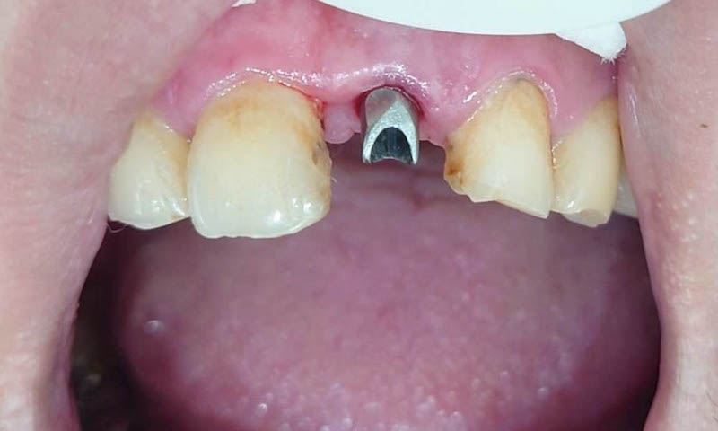評估牙周狀況尚佳，可使用即拔即種方式治療