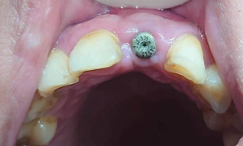 採即拔即種手術方式，在拔牙的同一個傷口上進行植牙