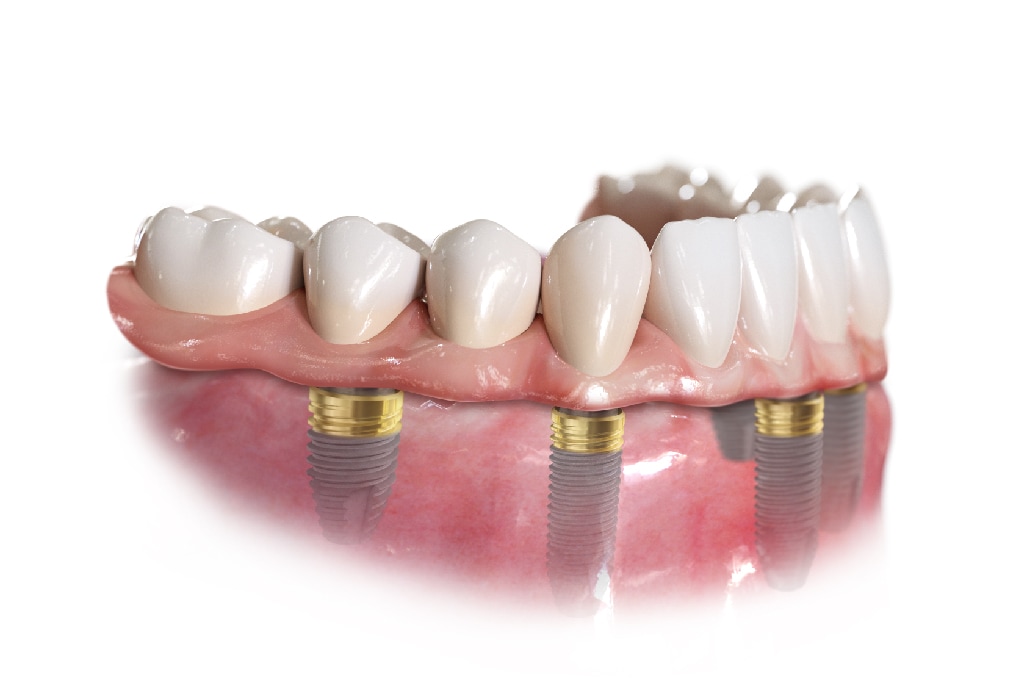 人工植牙-缺牙-植牙過程-三重植牙推薦-廖富洲醫師