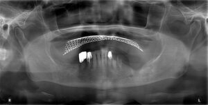植體周圍炎-重新植牙-補骨手術-三重植牙-推薦-廖富洲醫師