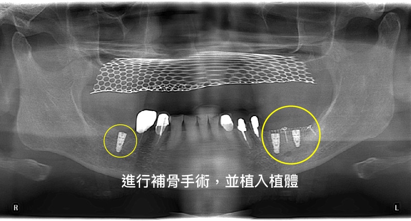 新北市三重區患者重新植牙中的X光片，進行補骨手術後重新植牙