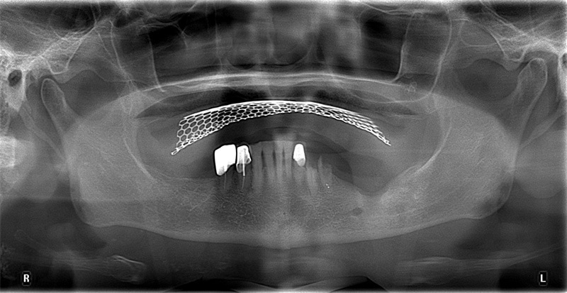 新北市三重區患者重新植牙前的X光片，因植體周圍炎導致骨頭發炎、吸收以致植體掉出