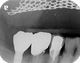 新北市三重區患者重新植牙後的X光片