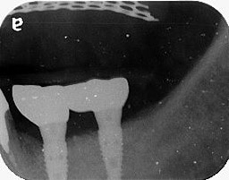 新北市三重區患者重新植牙後的X光片