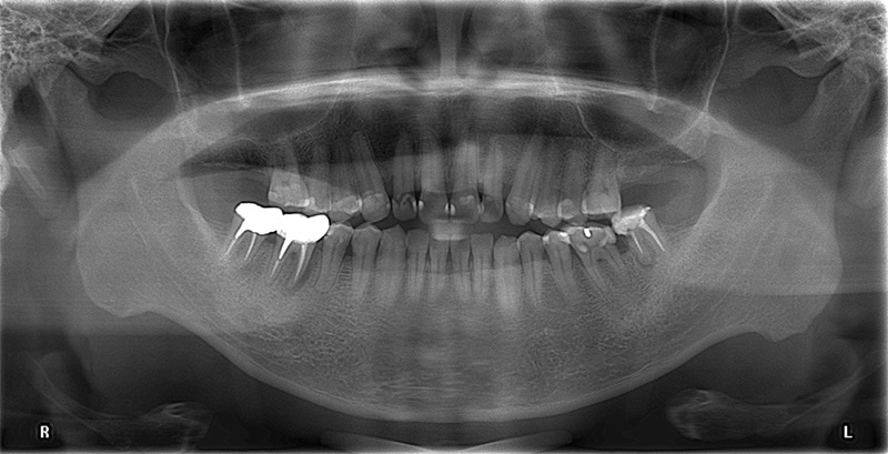 新北市三重區患者植牙前X光片，因牙周病引發口臭、牙齒搖晃等問題