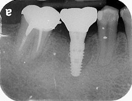 新北市三重區患者植牙後X光片