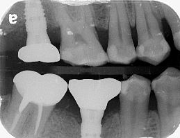 新北市三重區患者植牙後X光片