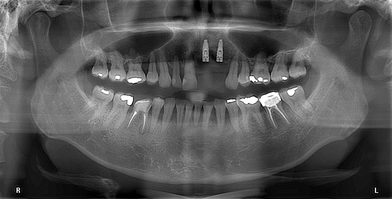 台北胡先生上顎左側正門牙和側門牙植入植體後的X光片，待人工牙根與骨頭緊密結合後再於植體上安裝假牙