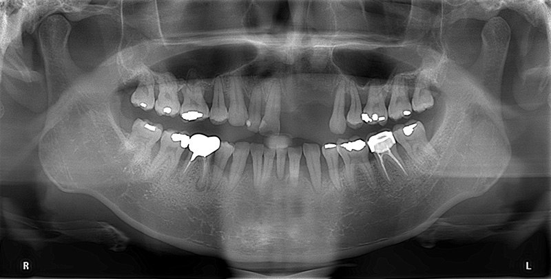 台北胡先生植牙前的X光片，牙齒搖晃且門牙缺牙