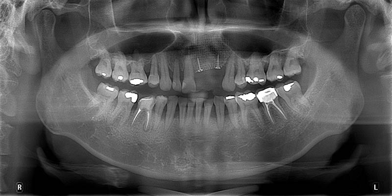 台北胡先生補骨後的X光片，為後續植牙打下穩固地基